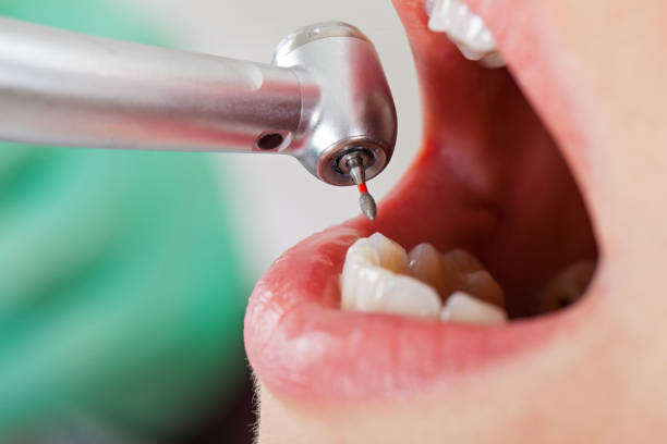 Best Emergency Tooth Extraction in Larned, KS
